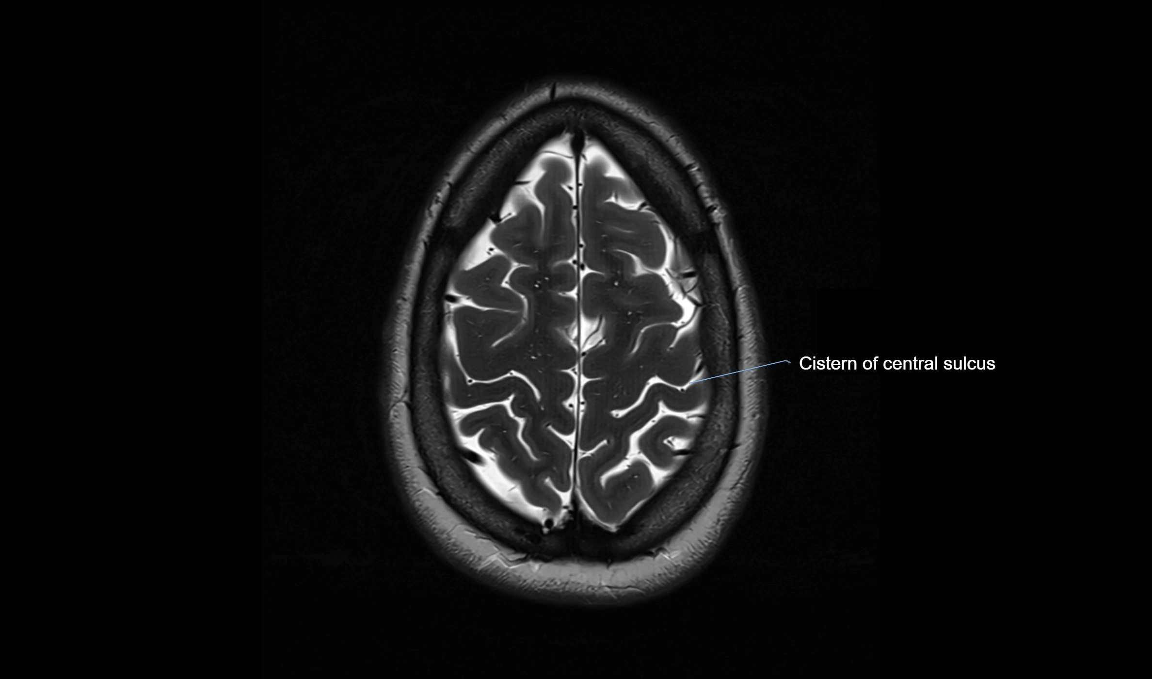 Brain cisterns  and ventricles  axial anatomy 3T MRI image-img-00001-00050.webp